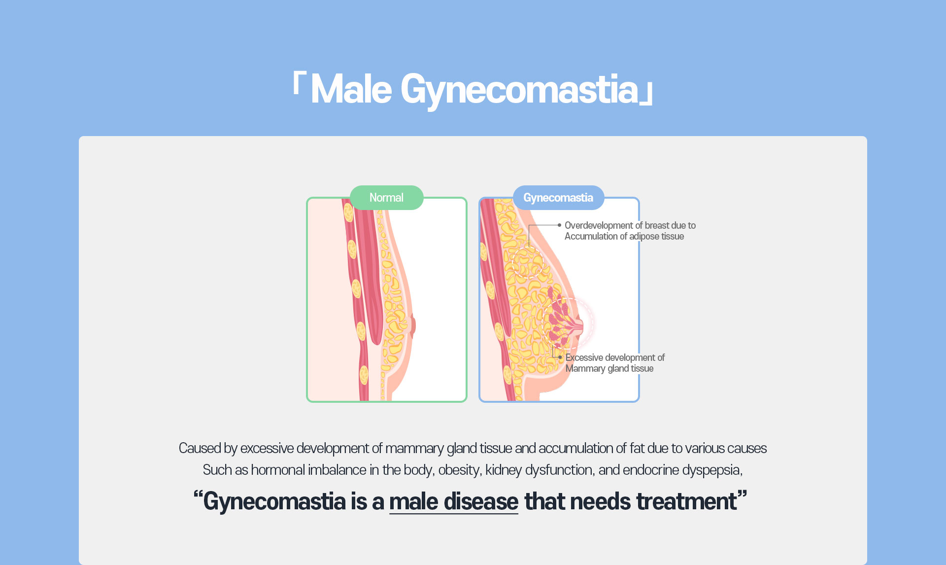 Double Gynecomastia