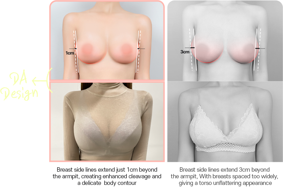 DA breast augmentation