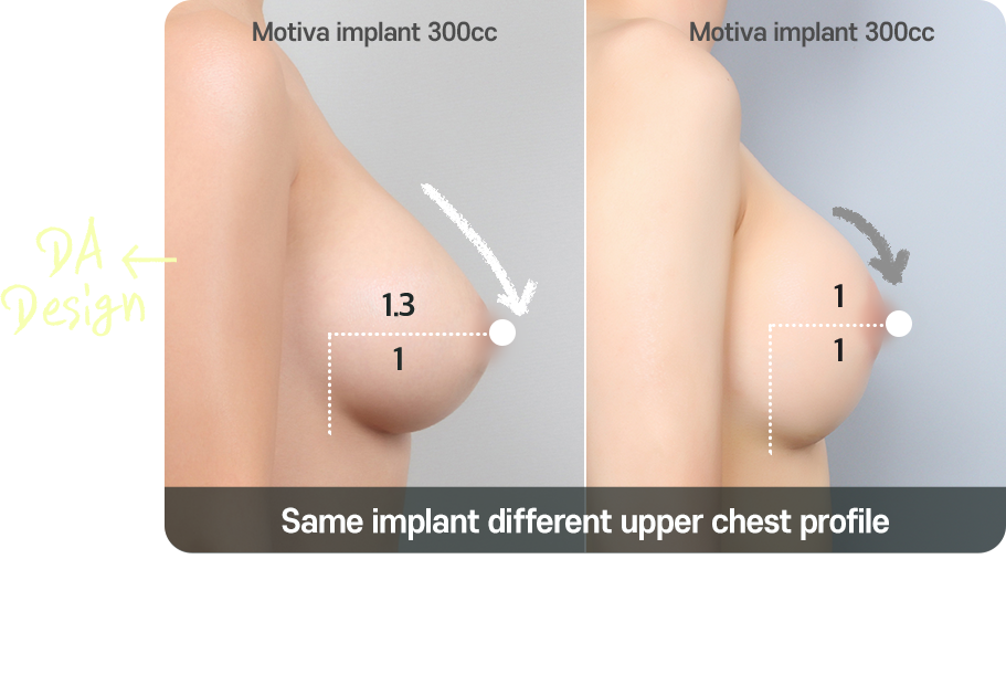 DA breast augmentation