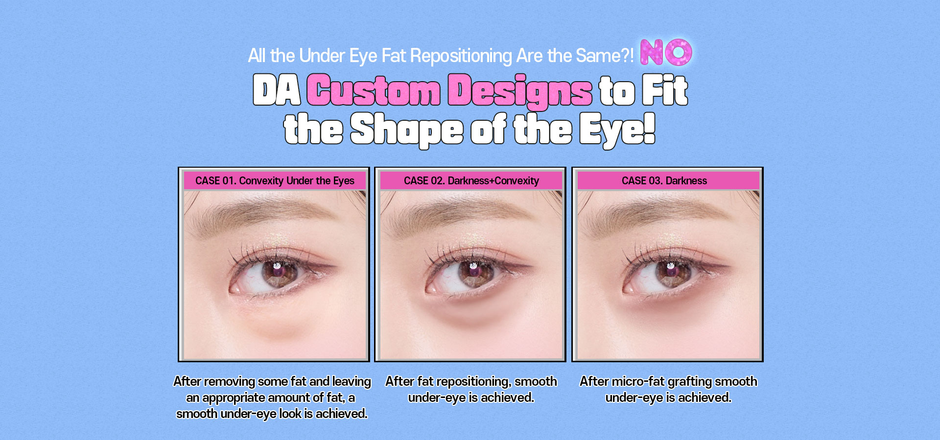 DA Under Eye Fat Repositioning