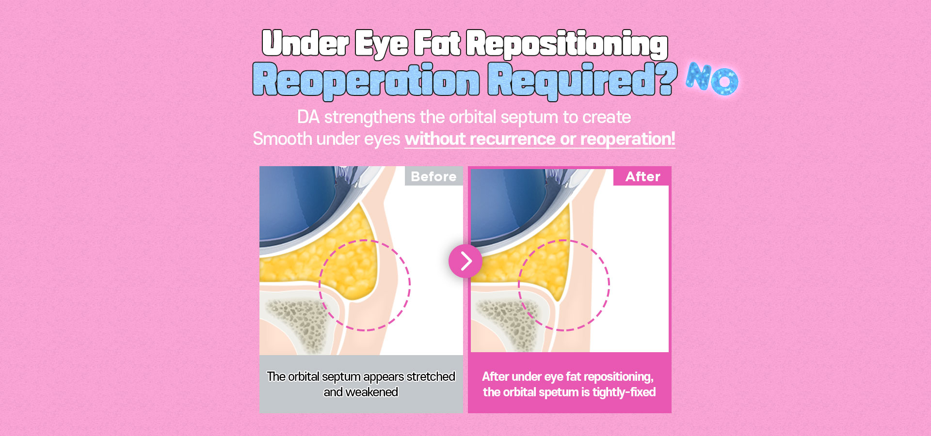 DA Under Eye Fat Repositioning