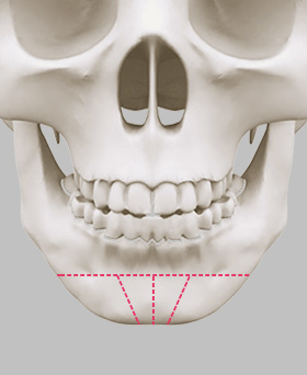 Intra-oral incision