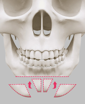 Osteotomy