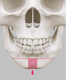 Intra-oral incision