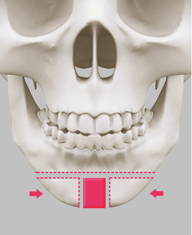 Osteotomy