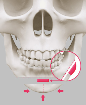 Bone Transplant