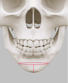 Fixing the bone