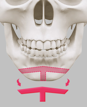 Osteotomy