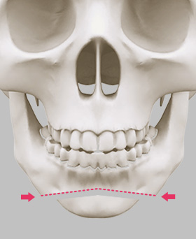 Bone Re-location