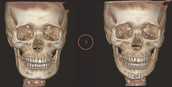 chin length CT BEFORE & AFTER