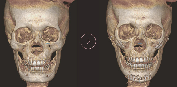 chin length CT BEFORE & AFTER