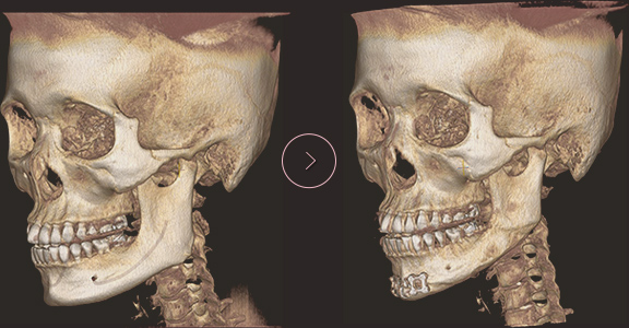 chin length CT BEFORE & AFTER