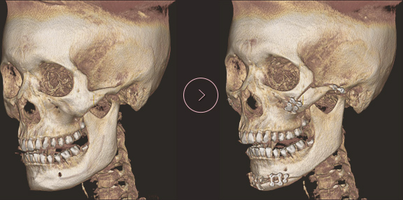 chin length CT BEFORE & AFTER