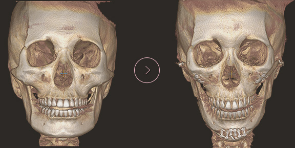 chin length CT BEFORE & AFTER