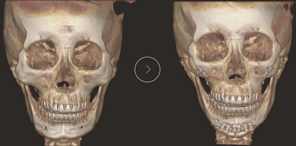 chin length CT BEFORE & AFTER