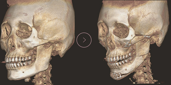 chin length CT BEFORE & AFTER