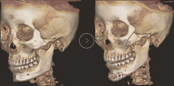 chin length CT BEFORE & AFTER