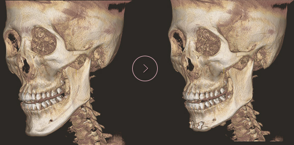 chin length CT BEFORE & AFTER