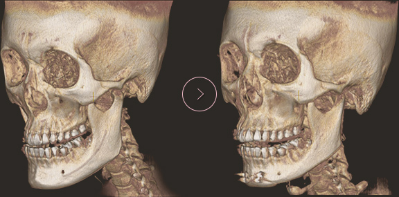 chin length CT BEFORE & AFTER