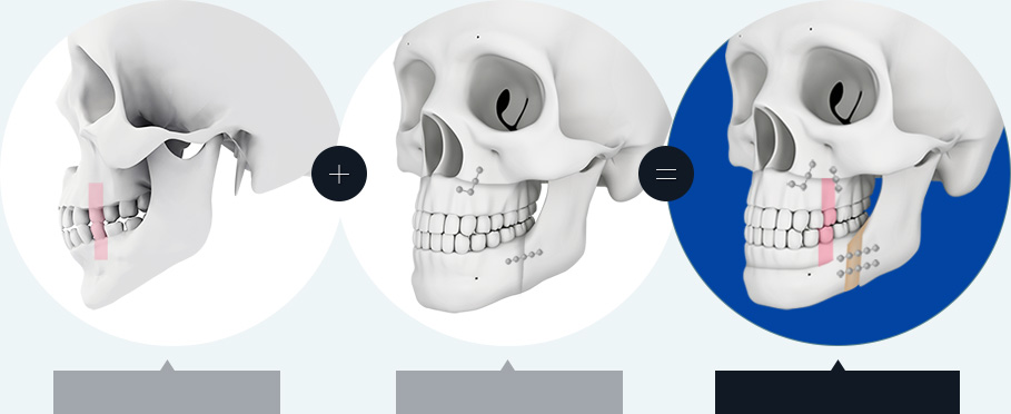 Protruded Mouth Surgery