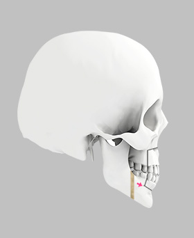 Mandibular jaw relocation