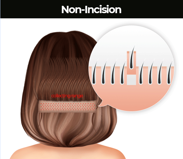 Non-incision