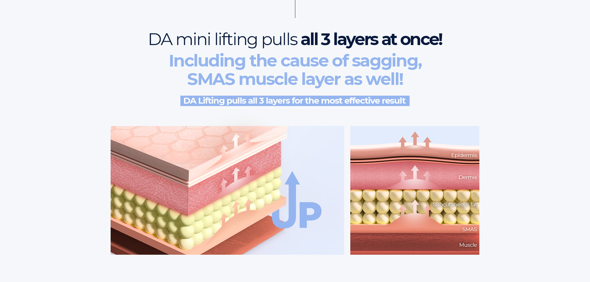 DA mini lifting pulls all 3 layers at once!