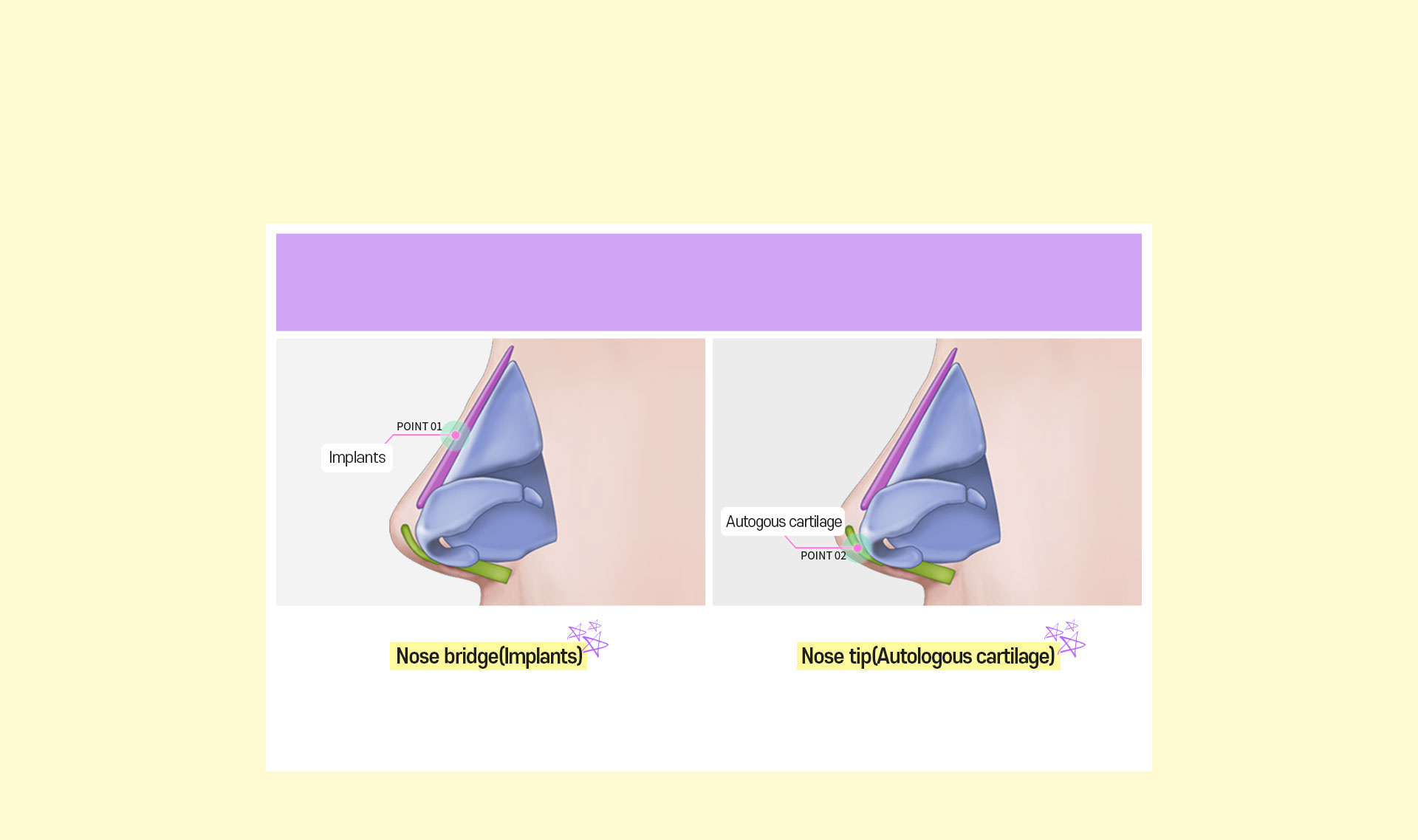 Flat Nose Surgery