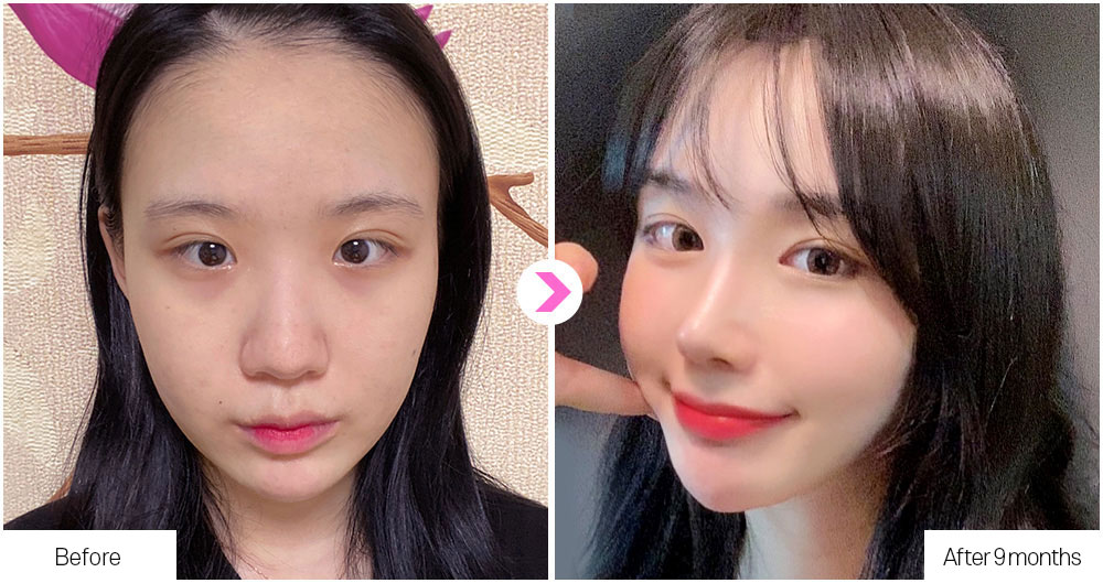 Flat Nose Surgery before&after