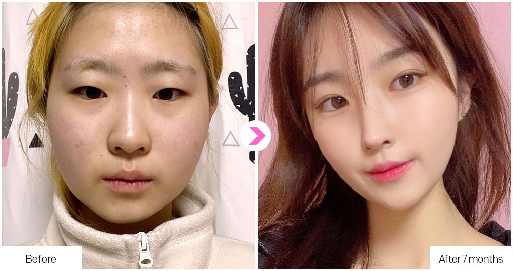 Flat Nose Surgery before&after