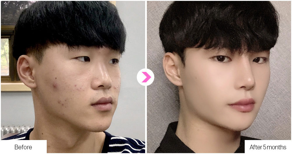 Flat Nose Surgery before&after