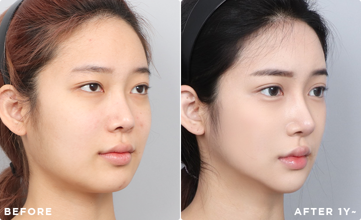 DA Revision Rhinoplasty