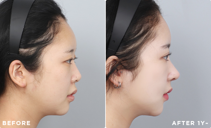 DA Revision Rhinoplasty