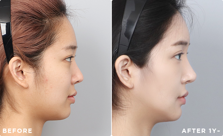 DA Revision Rhinoplasty