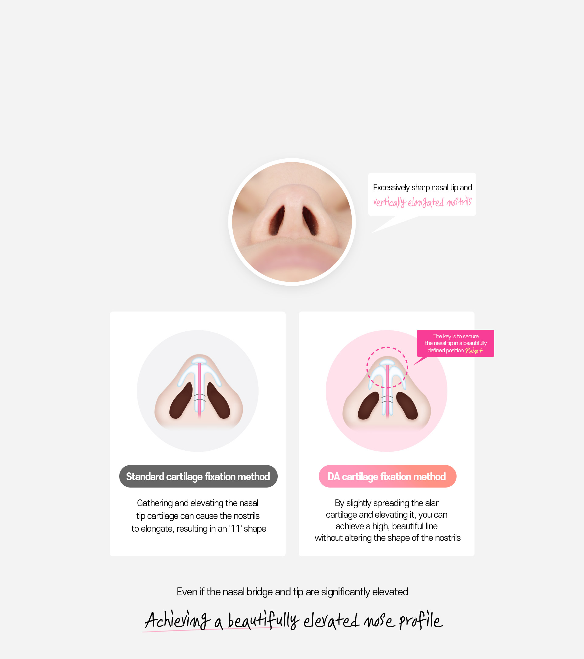 DA Revision Rhinoplasty