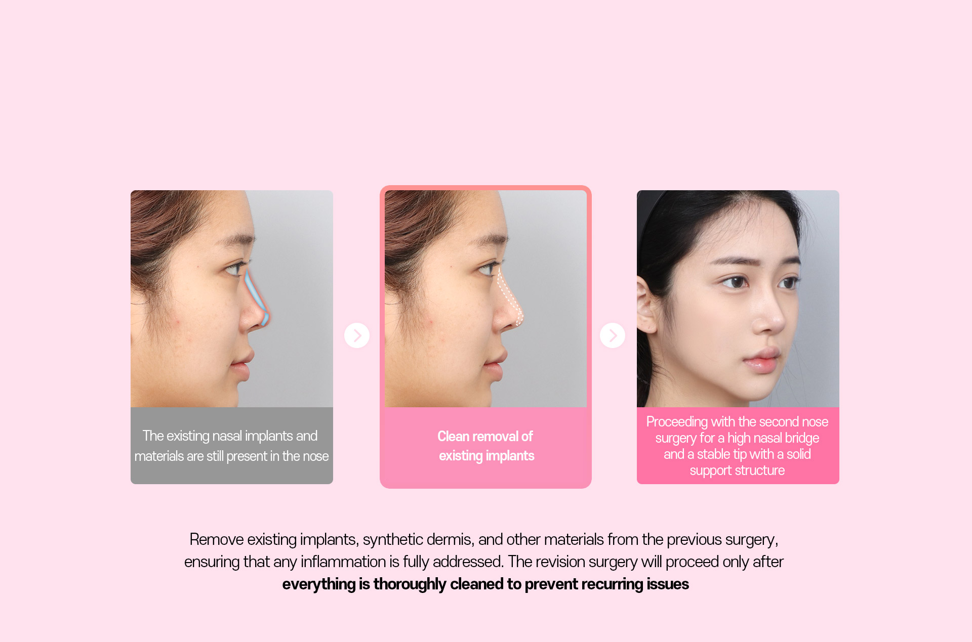 DA Revision Rhinoplasty