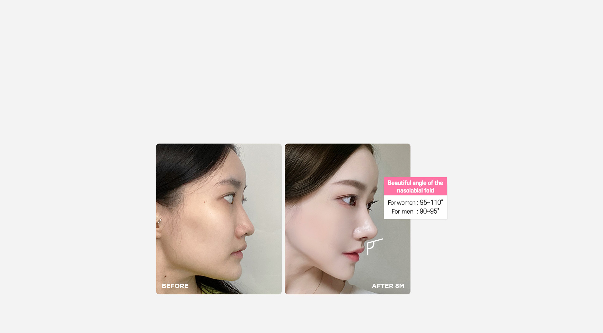 DA Revision Rhinoplasty